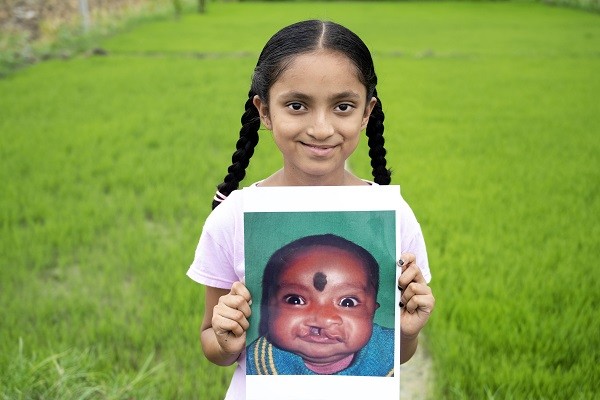 Smile Train India and Sirat Join Forces to Raise Cleft Awareness and Empower the Cleft Community Across India Smile Train India and Sirat Join Forces to Raise Cleft Awareness and Empower the Cleft Community Across India