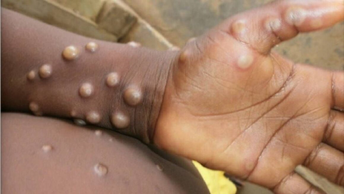 First Case Of Monkeypox Detected In Kerala, Centre On High Alert