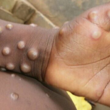 First Case Of Monkeypox Detected In Kerala, Centre On High Alert